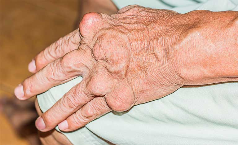 Bệnh gout có lây không? Làm thế nào để phòng ngừa bệnh gout?
