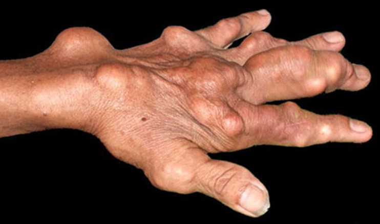 cách làm nhỏ cục Tophi