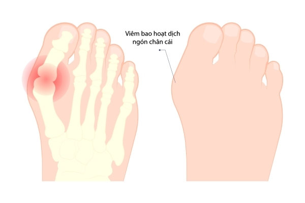 Sưng tấy ngón chân là bị gì?