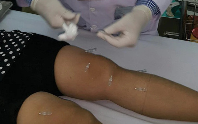 Phương pháp cấy chỉ điều trị bệnh gout: Những điều không thể bỏ qua