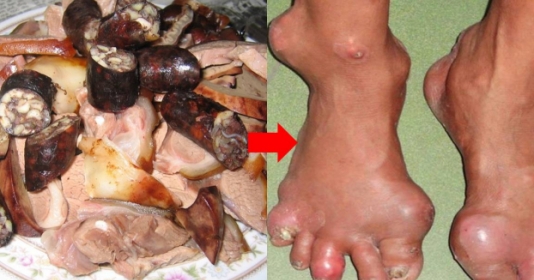 Bệnh gout có được ăn thịt chó không?