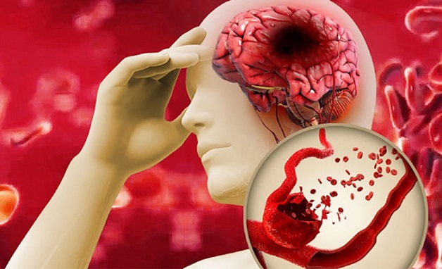 Mối quan hệ giữa bệnh gút và tim mạch
