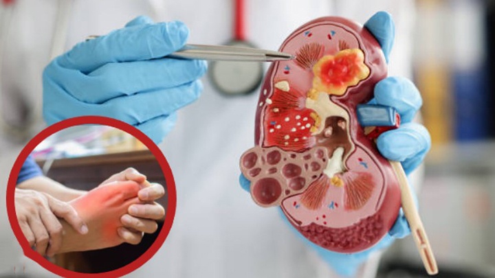 Triệu chứng bệnh gút mạn tính