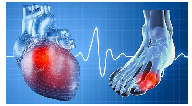 Triệu chứng bệnh gút mạn tính